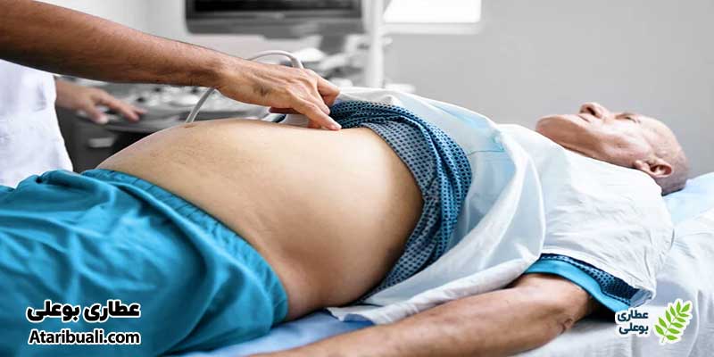 تجمع مایع در شکم در مردان (Ascites)
