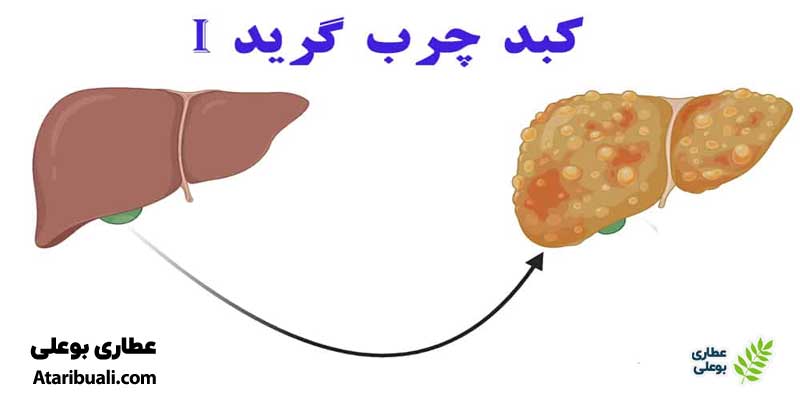 درمان قطعی کبد چرب گرید ۱