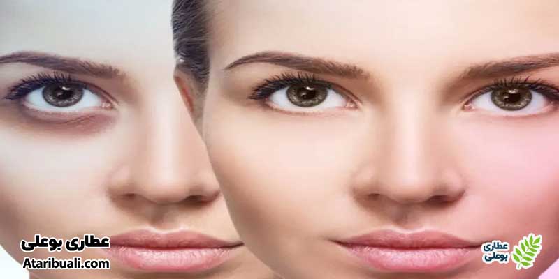 سیاهی و گودی زیر چشم