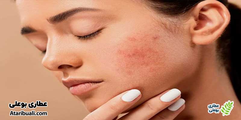 علائم کبد چرب روی پوست