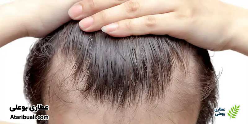 علائم کبد چرب و ریزش و سفیدی مو