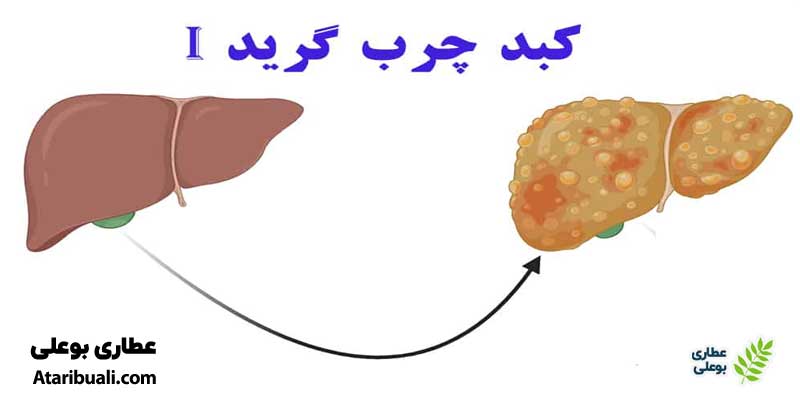 کبد چرب گرید یک (کبد چرب ساده)