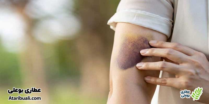 کبودی در قسمت‌های مختلف بدن