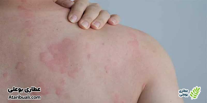 خواص عرق هل، درمان آلرژیهای پوستی