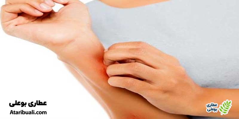 واکنش‌های آلرژیک