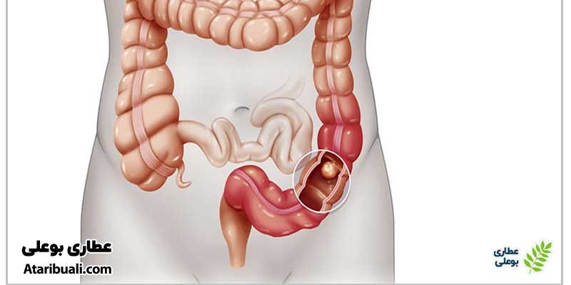 سندرم روده تحریک‌پذیر (IBS)