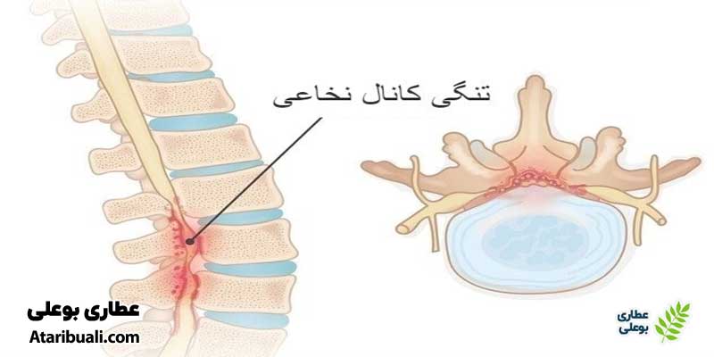 علائم سودا در ستون فقرات سوداوی‌ها
