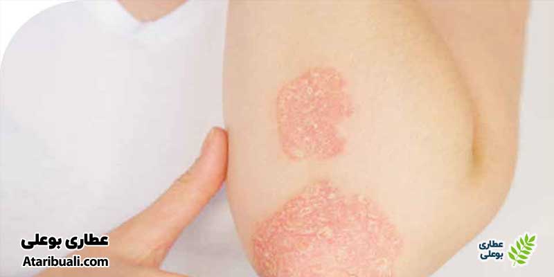 پسوریازیس (Psoriasis)