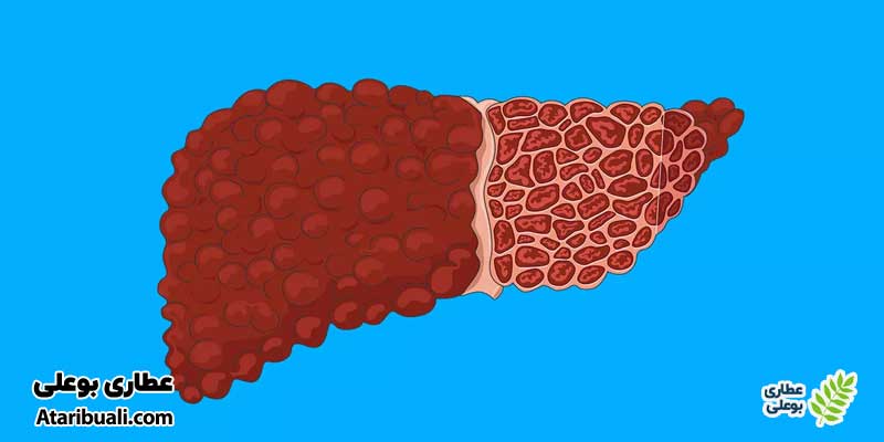 کدام گرید کبد چرب خطرناک است؟
