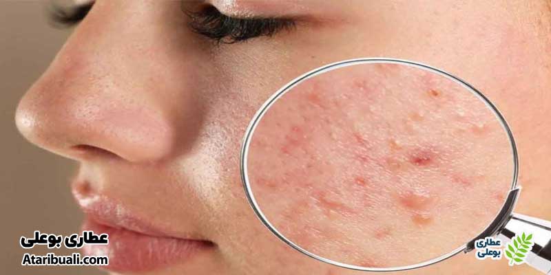 طریقه مصرف عرق شاتره برای جوش