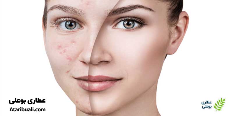 خواص عرق رازیانه برای لک صورت