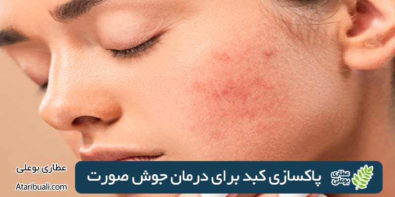 Cleansing the liver to treat acne