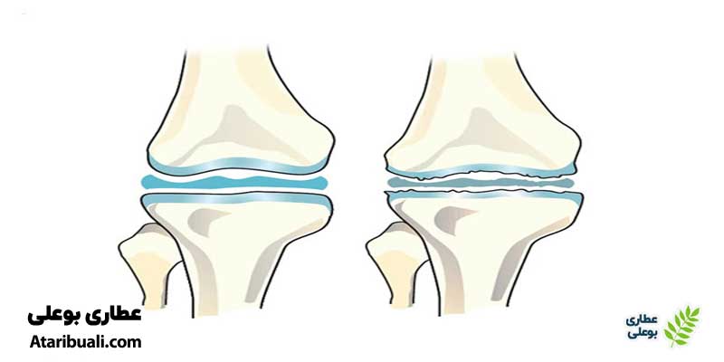 آرتروز چیست؟