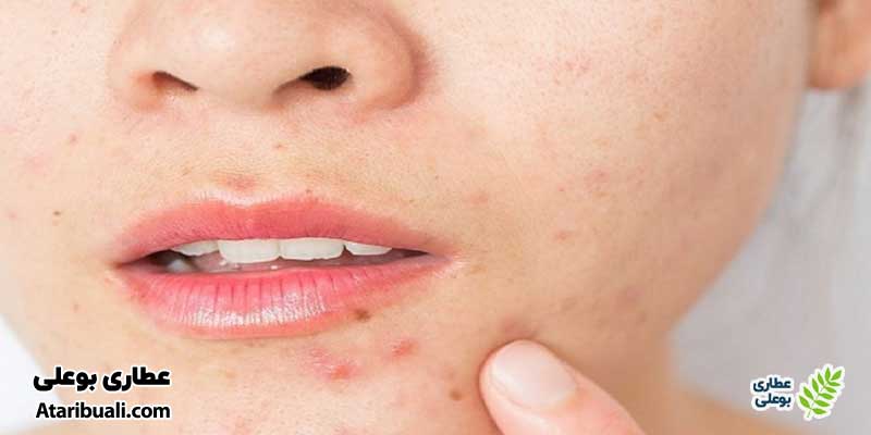جوش‌های کبدی چگونه است؟