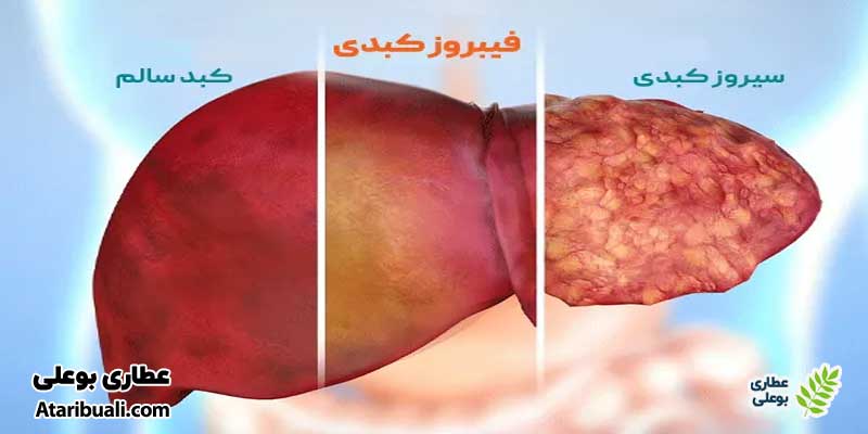 درمان فیبروز کبدی با داروی گیاهی کبد چرب کاژوا