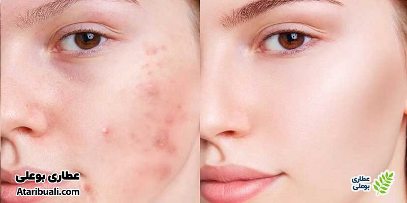 دیگر گزینه‌ها برای درمان جوش صورت