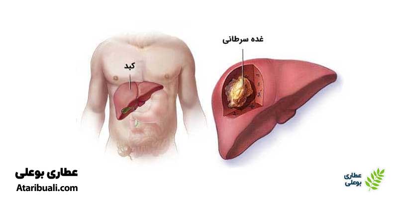 عوارض کبد چرب