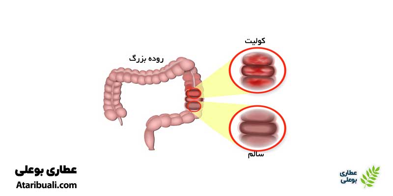 کمک به درمان کولیت روده با دارو گیاهی معده کاژوا