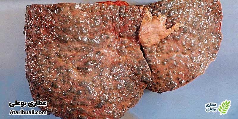 علل نارسایی کبدی مزمن