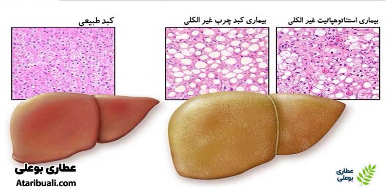 استئاتوهپاتیت غیرالکلی