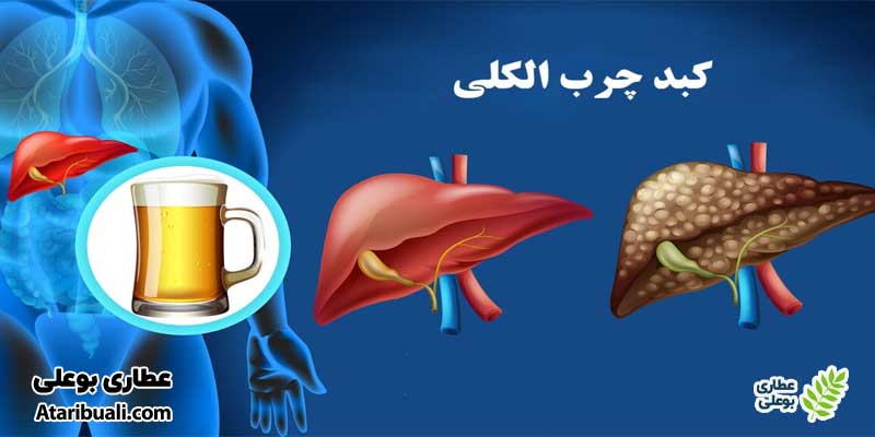 انواع کبد چرب الکلی (AFLD)