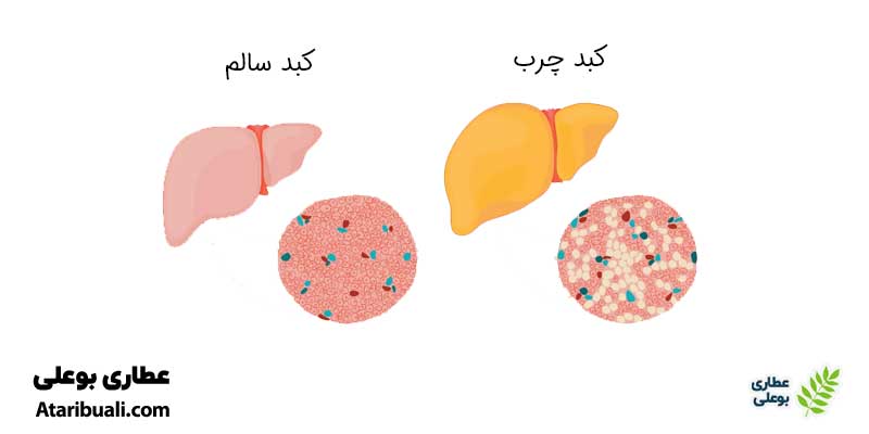 انواع کبد چرب