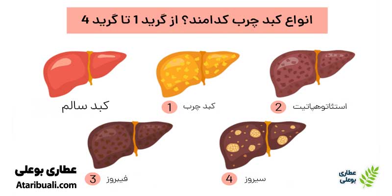انواع گرید کبد چرب