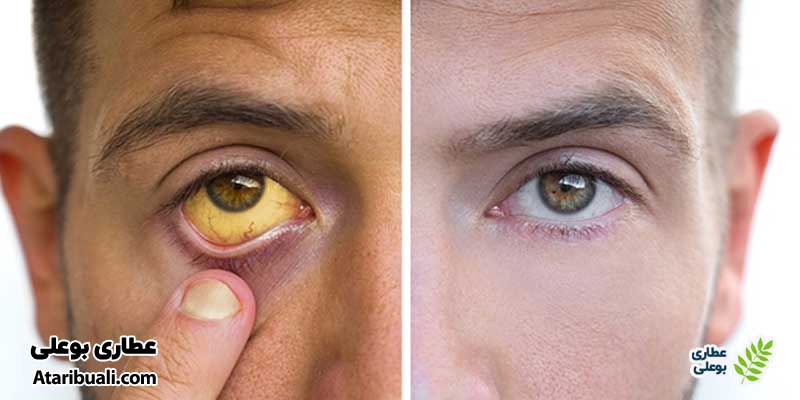 تشخیص کبد چرب، زردی پوست و سفیدی چشم‌ها (یرقان)