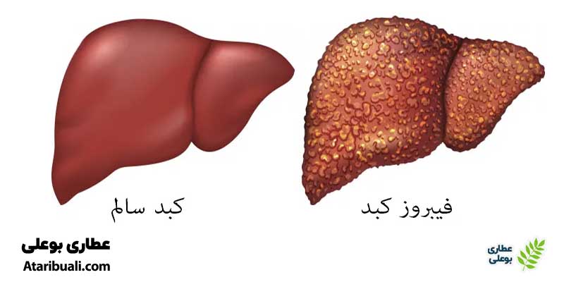 درجه‌بندی فیبروز کبدی
