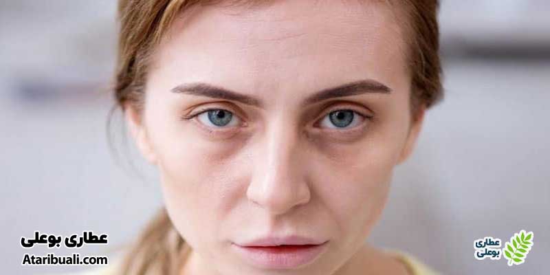 رنگ‌پریدگی یا خاکستری شدن چهره