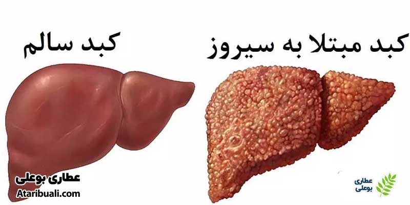 سیروز کبدی