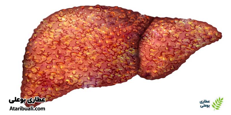 سیروز کبدی چیست؟