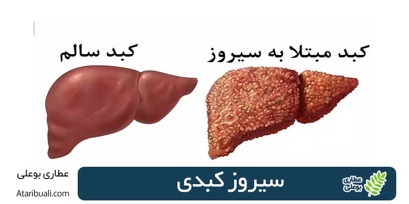 سیروز کبدی