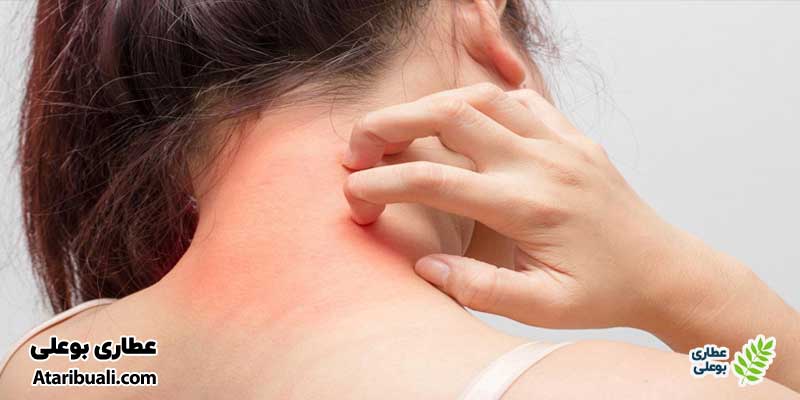 علائم سیروز کبدی