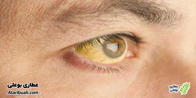 علائم فیبروز کبدی