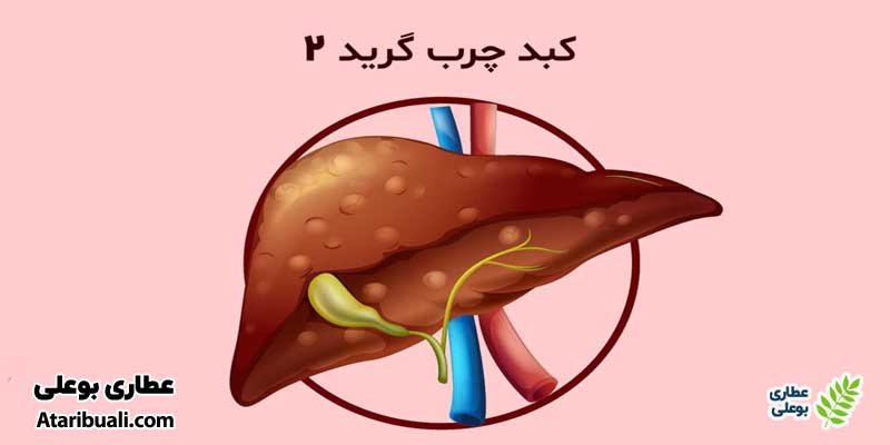 علت کبد چرب گرید 2