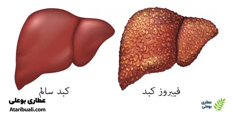 فیبروز کبدی