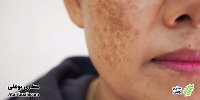 لکه‌های تیره روی پوست