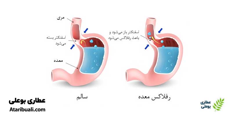 مشکلات گوارشی