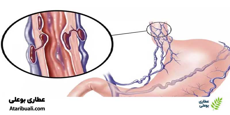 واریس مری و واریس معده