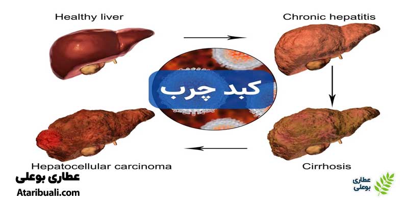 کبد چرب چیست؟