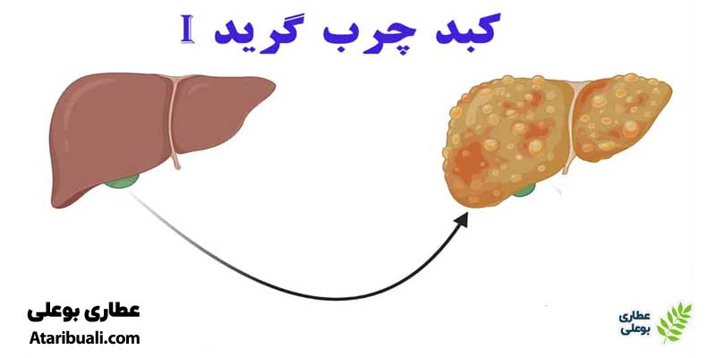 کبد چرب گرید 1 (کبد چرب ساده)