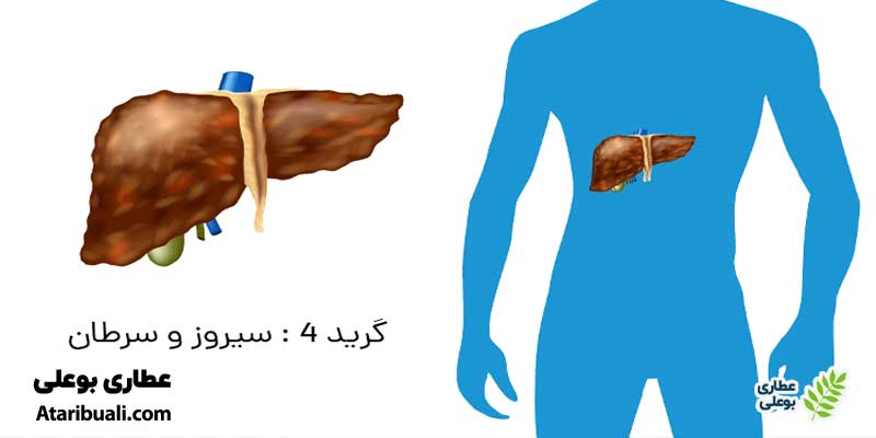 کبد چرب گرید 4 (سیروز)