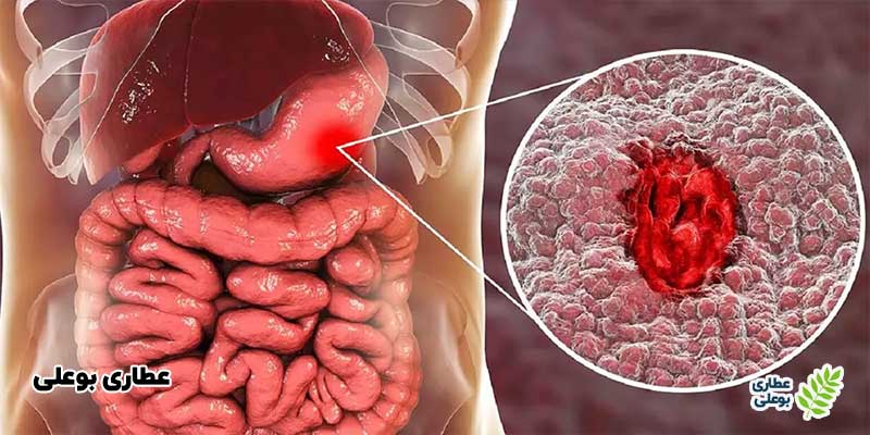 علائم پیشرفته و خطرناک ورم معده