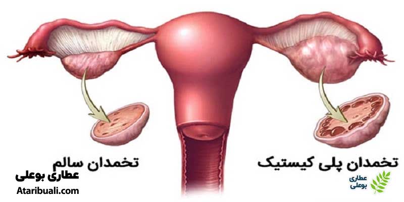 بیماری کبدی و اختلالات قاعدگی