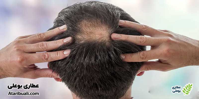 تأثیر بیماری کبد چرب روی سلامت مو