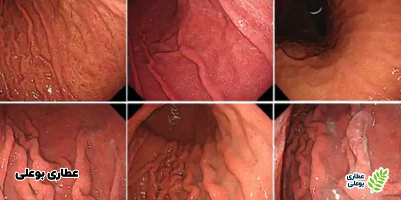 بررسی نتایج آندوسکوپی معده