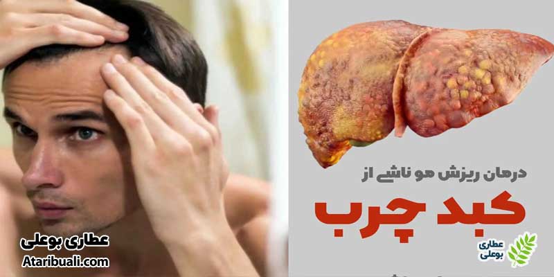 درمان و پیشگیری از ریزش مو ناشی از کبد چرب