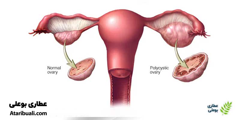 سندرم تخمدان پلی‌کیستیک(PCOS)