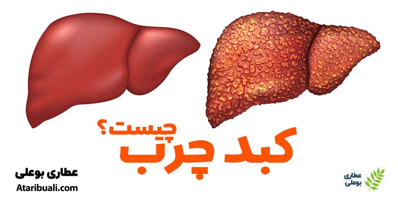 کبد چرب چیست؟